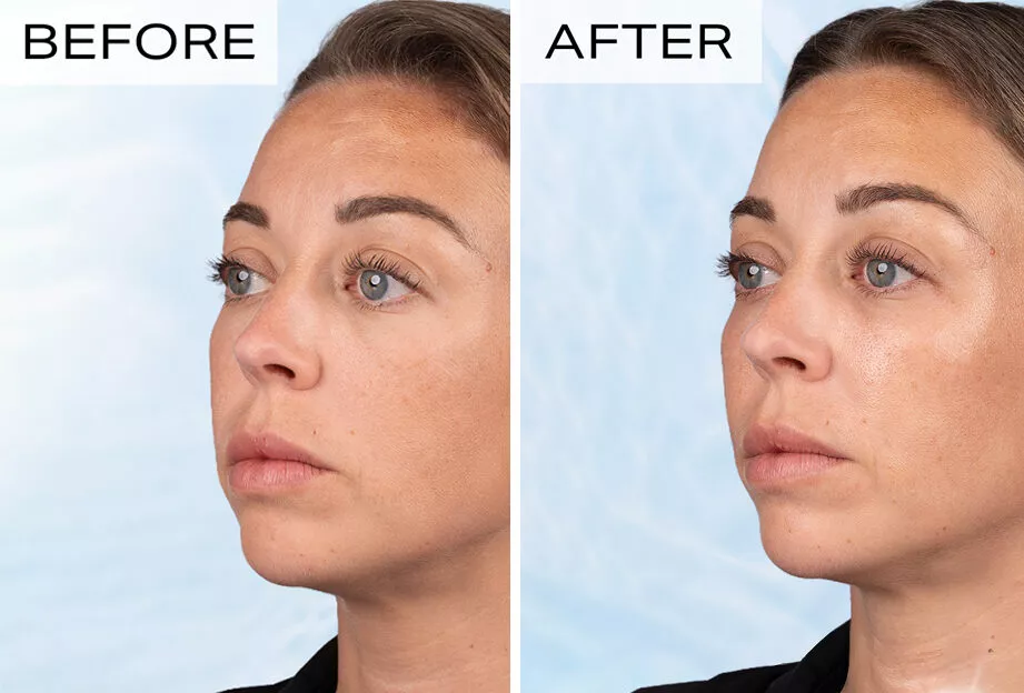 Skin before and after skin boosters